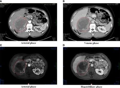 A large ectopic hepatocellular carcinoma with adrenal infiltration: a rare case report
